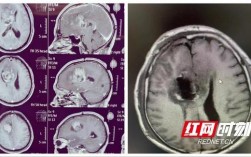 湖南省肿瘤医院：重塑脑肿瘤患者的生活