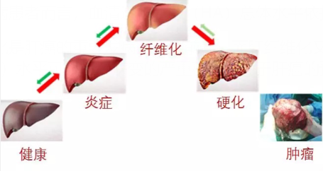 评估肿瘤病情的指标—血清透明质酸-图2