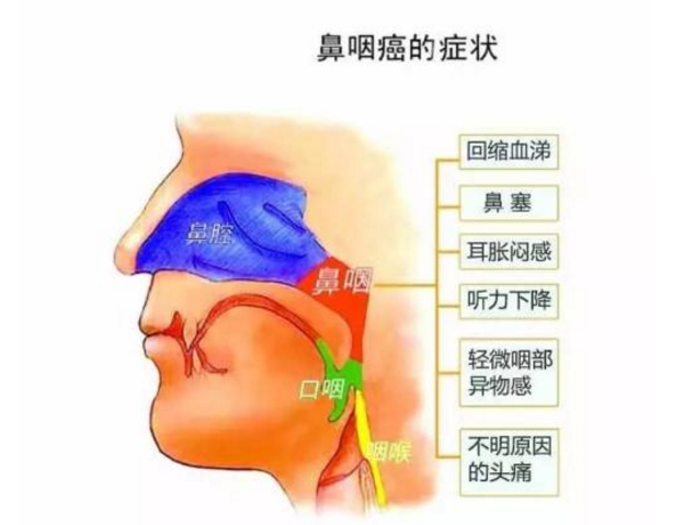 鼻腔和鼻窦癌的发病原因-图1