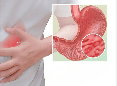 胃癌的发生和哪些因素有关？-图1